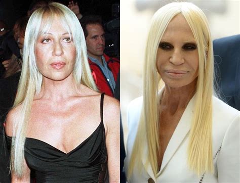 donatella before and after plastic surgery